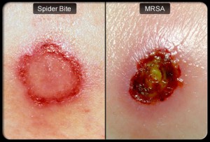 MRSA