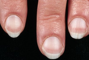 Pale nails