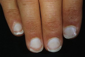 Sick nails