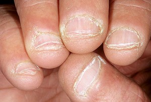 dermnet_photo_of_bitten_nails